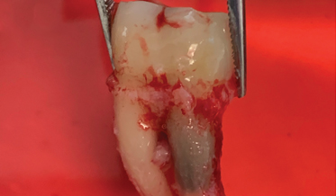 Intentional Replantation: No Longer a Last Resort for Saving a Natural Tooth