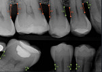 Fig 1. Some AI-powered technology measures the bone level from the CEJ to the crestal bone to provide radiographic evidence of bone loss that dentists can use in their clinical decision-making. (Source: Overjet, Inc. illustration)