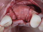 Fig 1. Example of periosteal biting stabilizing sutures for GBR with a resorbable collagen membrane.
