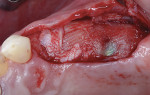 Fig 6. Uncovery of the site for placement of healing abutments revealed complete defect fill and regeneration.