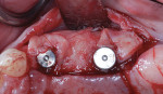Fig 7. Connective tissue graft was utilized at the time of implant uncovery to improve the soft-tissue profile.