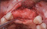 Fig 17. Occlusal view of ridge after healing.