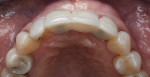 Fig 22. Occlusal view of final implant-supported restoration.