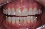 Fig 2. Pretreatment, teeth apart revealing the patient’s esthetic concerns.