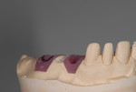 Fig 6 through Fig 8. Model before (Fig 6), during (Fig 7), and after
(Fig 8) adjustment of the soft-tissue material apically to mimic the ideal
tooth length (Nos. 12 through 14) and preparation of the ovate pontic
site.