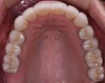 Fig 12. Post-treatment, occlusal view
of maxillary arch.