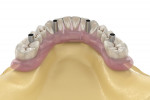Fig 3. A medium-size jaw setup, with graphic
depiction of the overlaying restorative material.