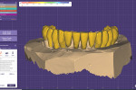 Fig 13. Virtual tooth setup. Occlusal markings indicate
strength of opposing contacts.