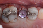 Fig 11. Occlusal view of
implant postoperative with one-stage surgery.