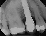 Fig 15. Radiograph of final implant-supported
restoration 1-year post implant placement.
