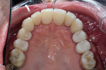 Fig 12. Post-treatment occlusal view, maxillary arch.