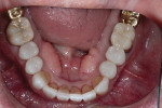 Fig 13. Post-treatment occlusal view, mandibular arch.