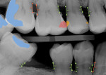 Fig 2. A radiograph
with AI findings. Blue = prior
restorations. Red and orange =
areas detected by AI that are
suspicious for caries. AI also
shows bone level measurements.
(Image: Overjet, Inc.)
