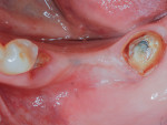 Fig 2. (Case 1) Preoperative occlusal view; note mandibular left first and second molars missing, and associated tissue loss volume.
