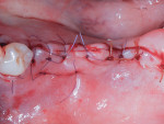 Fig 7. Primary closure with two horizontal mattress sutures for tension reduction at the flap margin, and single simple interrupted
sutures along the length of the flap.