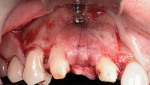Fig 15. Secured laminar
plate over the graft material using single stabilization suture wrapped around the apical fixation screw and anchored to the palatal flap; note the
additional screw providing initial stability of the laminar plate.