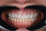Fig 8. Smile design try-in and evaluation, confirming
the proper position of the new gingival margin.