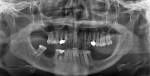 Fig 2. Panoramic radiograph, pretreatment. Note the mandibular left quadrant,
showing atrophy and compromised tooth No. 21.
