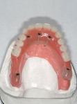 Figure 15   Occlusal view of the prefabricated all-acrylic resin provisional prosthesis connected to the standard-length implants.