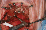 Figure 14  Intraoral view of a 3-mm twist drill entering the surgical template in the area of the planned entry point for the zygoma implant.