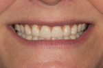 Figure 1 Preoperative view of the patient’s smile exhibiting worn anterior veneers and a high gingival smile line.
