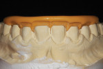 Figure 6 A length wax-up of the model was conducted in the laboratory