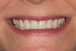 Figure 12 Postoperative smile after cementation of the veneers.