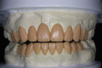 Figure 4 A diagnostic wax-up was completed to address both esthetic and functional concerns.