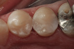 Figure 2 Immediate postoperative view of Class II restorations restored with a bulk-filled composite resin.