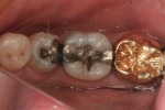 Figure 8 In a separate case, tooth No. 19 had a failing amalgam with recurrent decay and required a full-coverage indirect restoration.