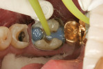 Figure 10 An automix, dual-cure composite resin build-up material was injected into the preparation.