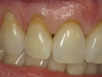 Figure 6 Teeth Nos. 7 and 8 present with abfractions that were of cosmetic concern to the patient.