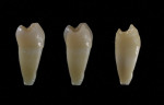 An observation of natural dentition stripped of its enamel layer shows the natural layering that should be applied to layered restorations.