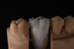 Enamel layer is overlaid to create the natural composition of the previous cusp tip that had chipped away.