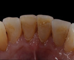 The patient presented with a rough lingual surface on his lower central incisor.