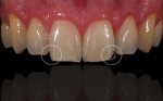 The adjacent teeth were analyzed to determine color selection.