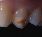 The patient presented with both an esthetic and hygienic concern on her upper bicuspid.