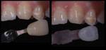 A shade was taken for the natural dentin and a custom ceramic tab was created.