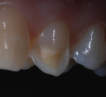 Natural incisal edge was preserved by the dentist.