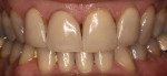 The patient presented with her unsatisfactory and old veneers.