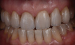 The finished case demonstrates the major improvement esthetically by incorporating six additional veneers into the treatment plan without preparing anything other then the old restorations.