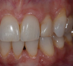 A common complaint from patients exhibiting abfractions is tooth sensitivity.