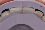 Figure 8 A facial contour matrix based on
the trial smile model was used to verify facial thickness of the composite restorations
for facial support.