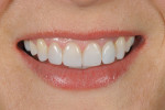 Figure 10 The resulting nanohybrid composite restorations demonstrated polychromicity and contributed to a natural smile appearance.