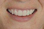 Figure 2 The trial smile enabled observation of the lower lip position during smiling, speaking, and repose.