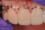 Figure 3 With the trial smile in place, a
permanent marker pen was used to indicate the desired gingival heights for planning crown lengthening and the gingivectomy.