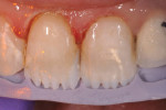 Figure 6 To allow the more opacious composite to “break up” areas of translucency in the incisal edge and better duplicate nature, the incisal edge was cut back.
