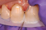 Figure 5 An opacious OB shade of nanohybrid composite was applied to the incisal edges of teeth Nos. 8 and 9.