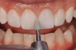 Figure 13 A fine polishing point was used to remove any interproximal scratches and smooth the final composite restorations.