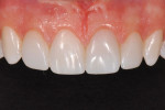 Figure 14 Close-up postoperative view of the completed nanohybrid direct composite restorations.